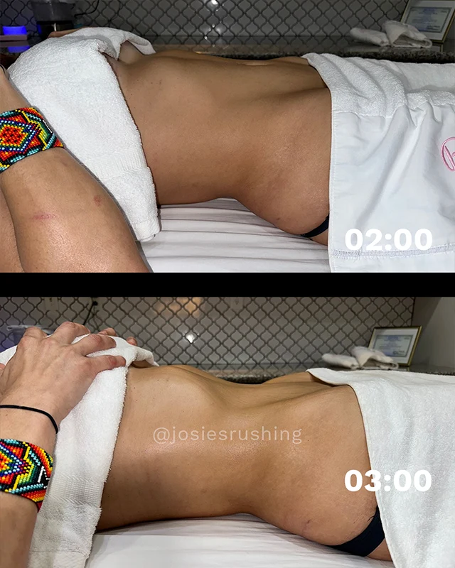Before and After - Brazilian Lymphatic