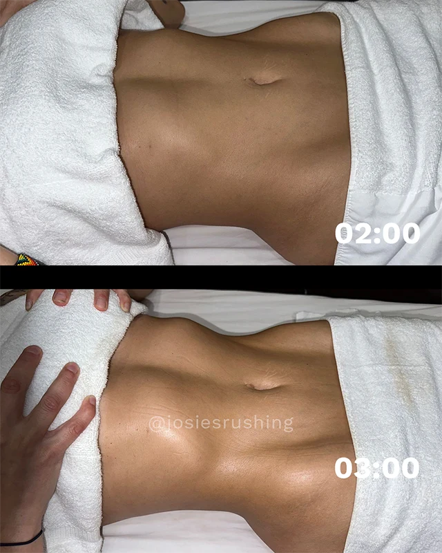 Before and After - Brazilian Lymphatic