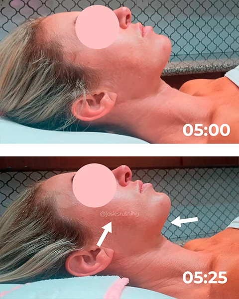 Before and after - Authentic Brazilian Lymphatic™