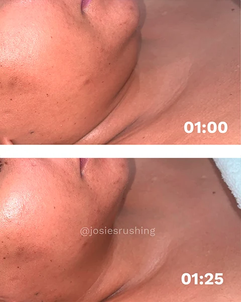 Before and after - Authentic Brazilian Lymphatic™