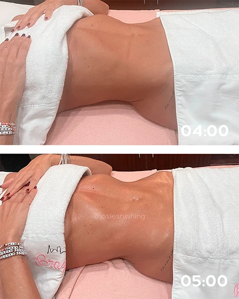 Before and after - Authentic Brazilian Lymphatic™