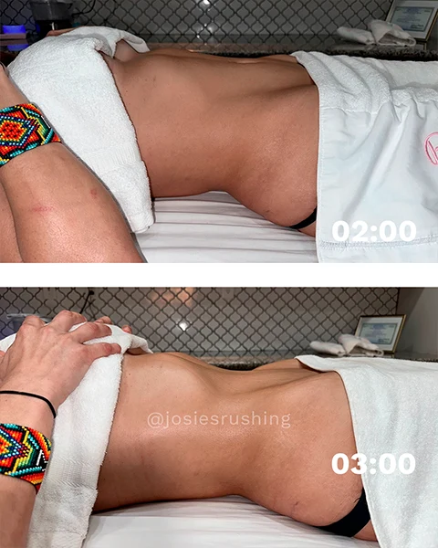 Before and after - Authentic Brazilian Lymphatic™