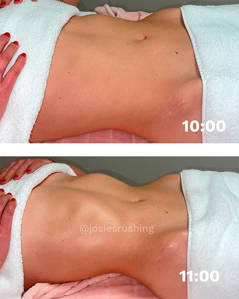 Before and after - Authentic Brazilian Lymphatic™