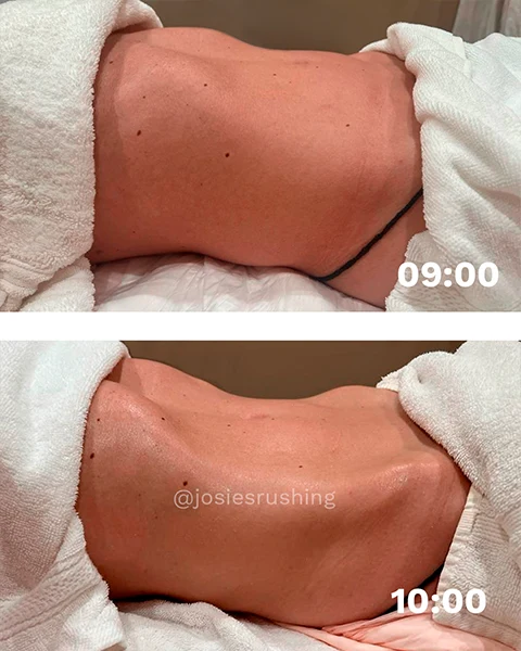 Before and after - Authentic Brazilian Lymphatic™