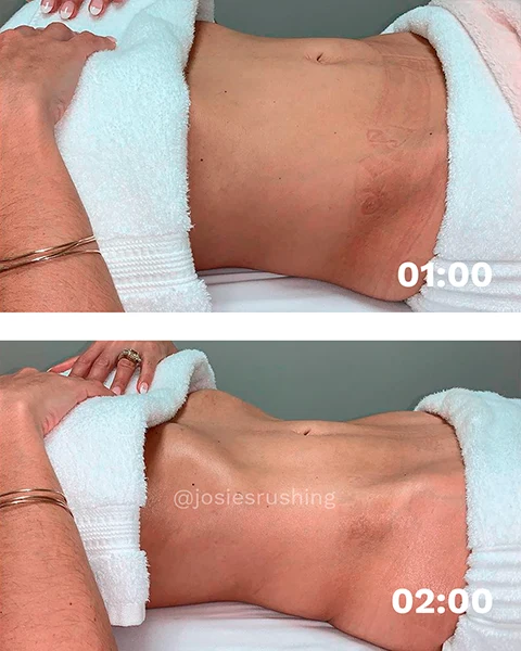 Before and after - Authentic Brazilian Lymphatic™