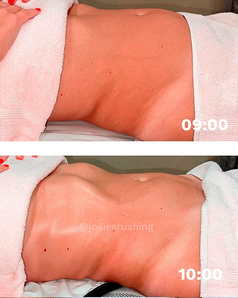 Before and after - Authentic Brazilian Lymphatic™