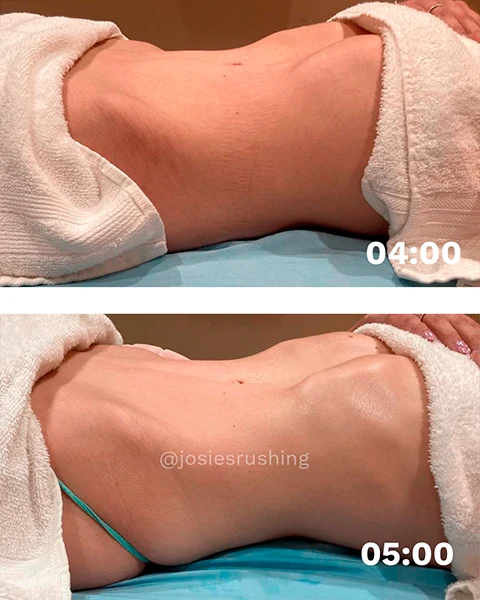 Before and after - Authentic Brazilian Lymphatic™